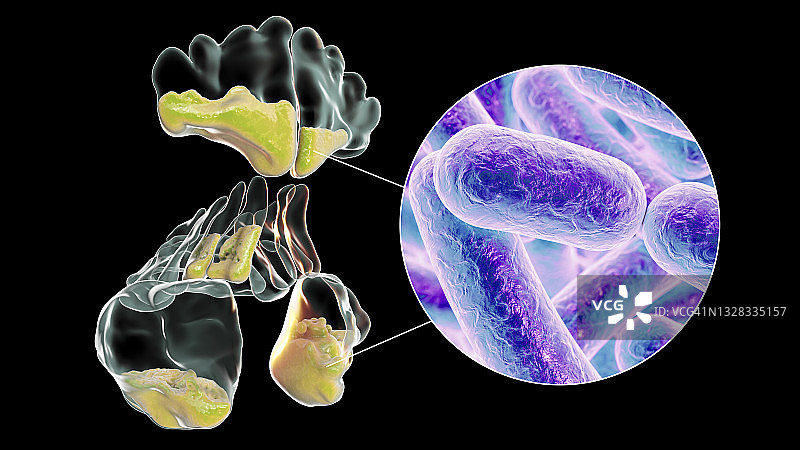 鼻窦炎插图图片素材