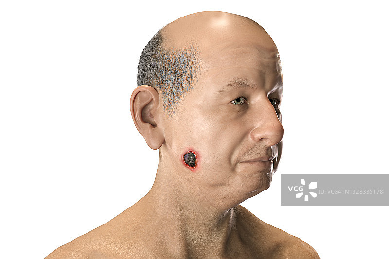 皮肤炭疽病插图图片素材