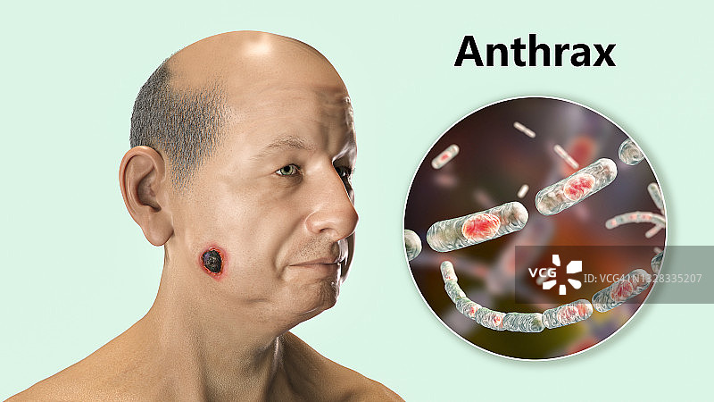 皮肤炭疽病插图图片素材