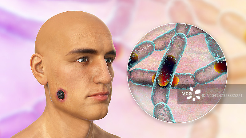 皮肤炭疽病插图图片素材