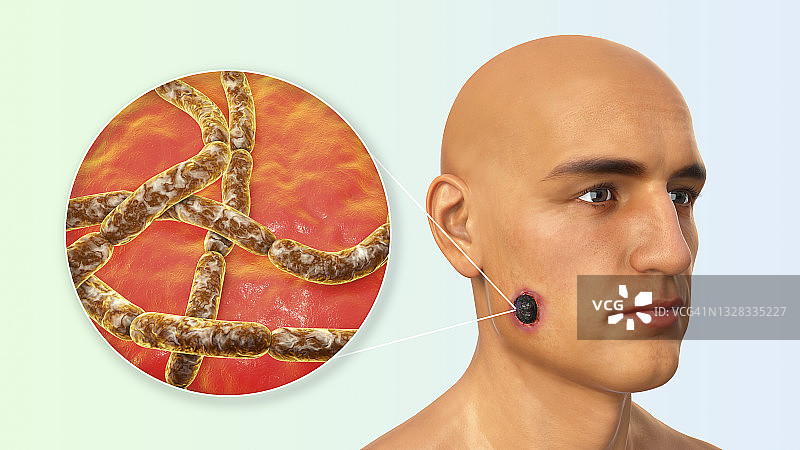 皮肤炭疽病插图图片素材