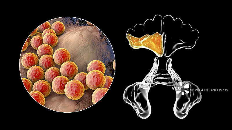 鼻窦炎插图图片素材