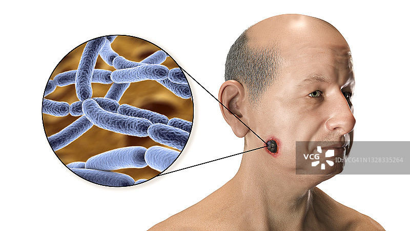 皮肤炭疽病插图图片素材