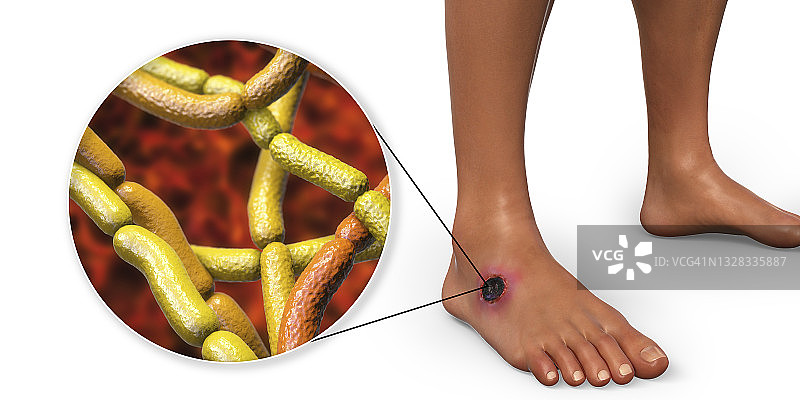 皮肤炭疽病插图图片素材