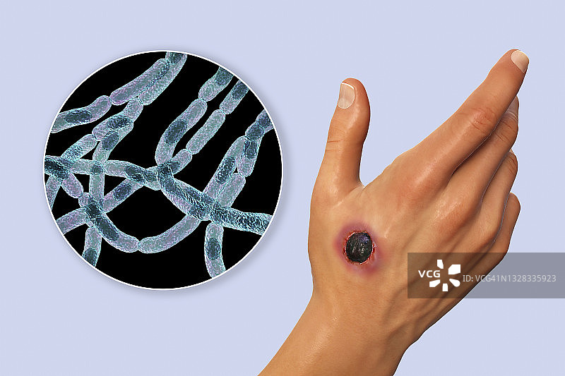 皮肤炭疽病插图图片素材