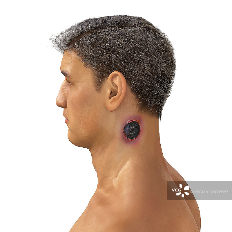 皮肤炭疽病插图图片素材