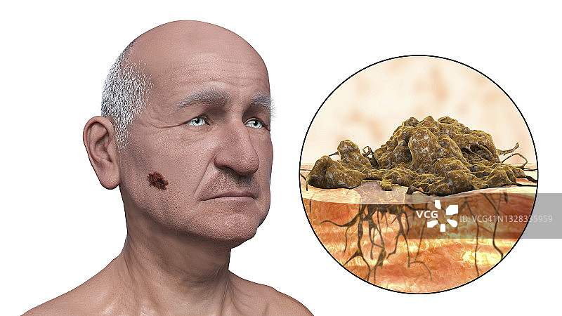 黑色素瘤插图图片素材