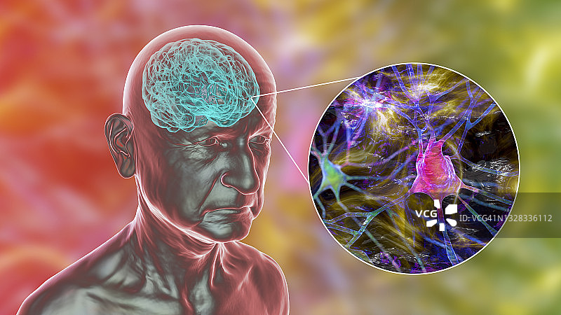 痴呆症概念图图片素材