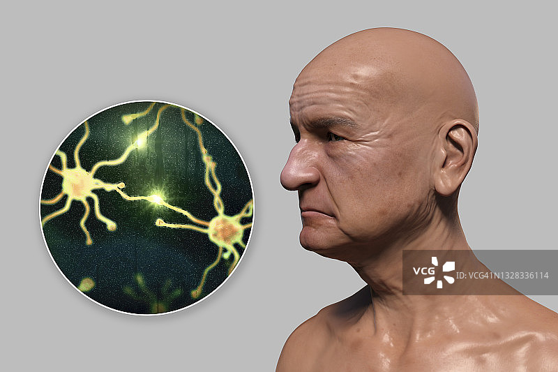 痴呆症概念图图片素材