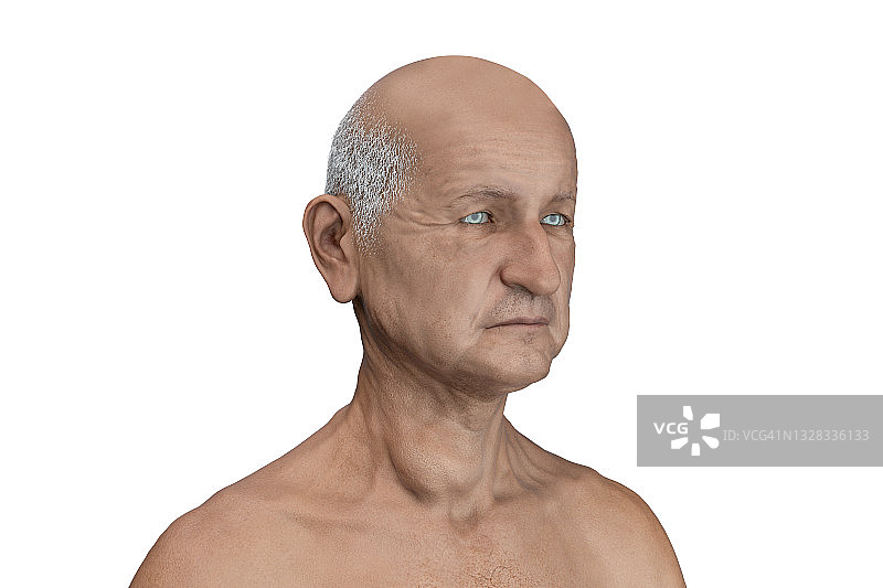 甲状腺肿瘤插图图片素材