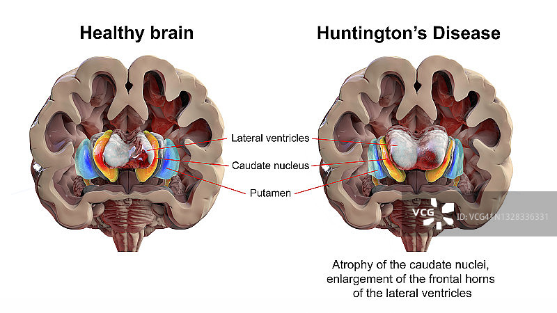 正常大脑与亨廷顿舞蹈症患者大脑插图图片素材
