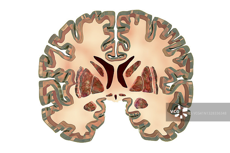 健康大脑的冠状切面图图片素材