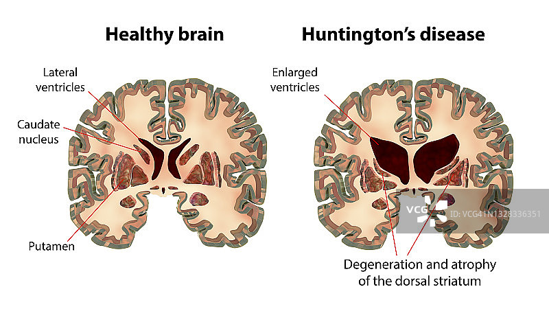 正常大脑与亨廷顿舞蹈症患者大脑插图图片素材