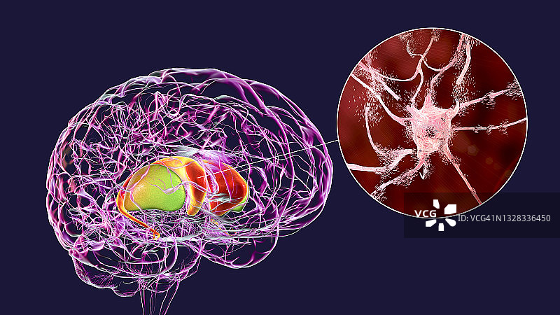 亨廷顿舞蹈症中的背侧纹状体，图示图片素材