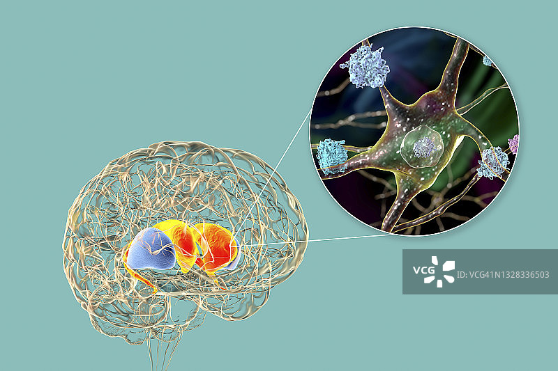 亨廷顿舞蹈症中的背侧纹状体，图示图片素材