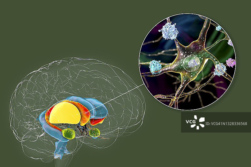 亨廷顿舞蹈症中的背侧纹状体，图示图片素材