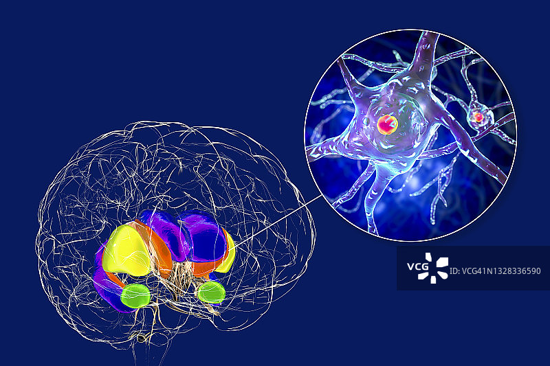 亨廷顿舞蹈症中的背侧纹状体，图示图片素材