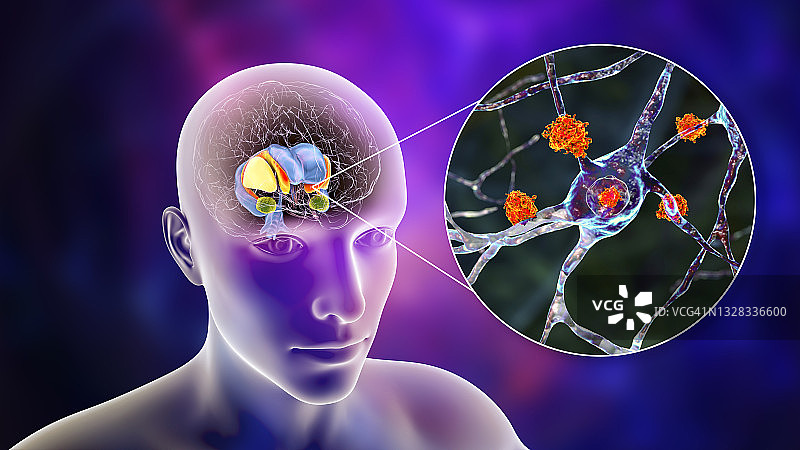 亨廷顿舞蹈症中的背侧纹状体，图示图片素材