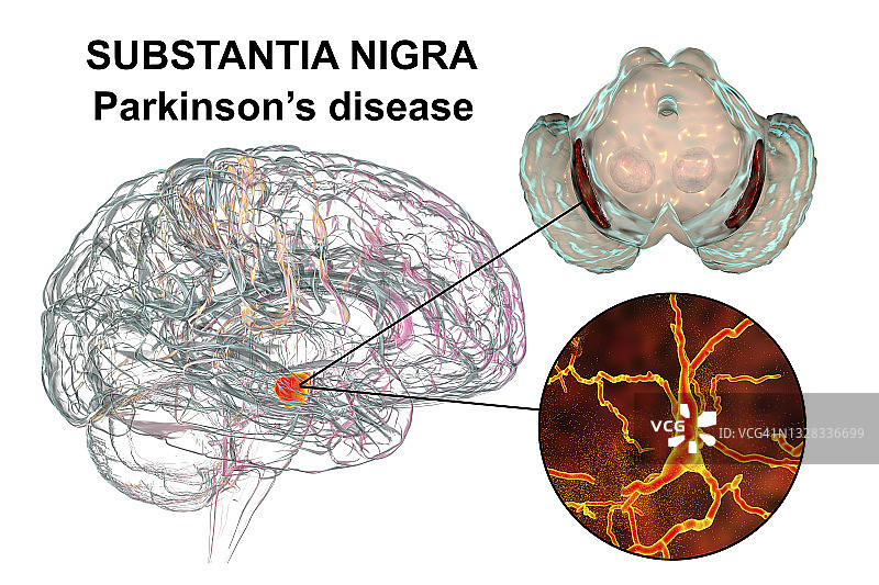 帕金森病黑质示意图图片素材