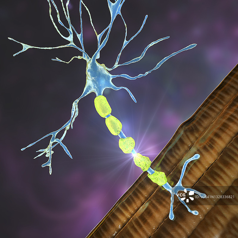 脱髓鞘疾病，图示图片素材
