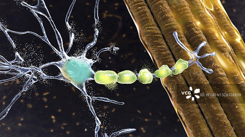 运动神经元退化插图图片素材