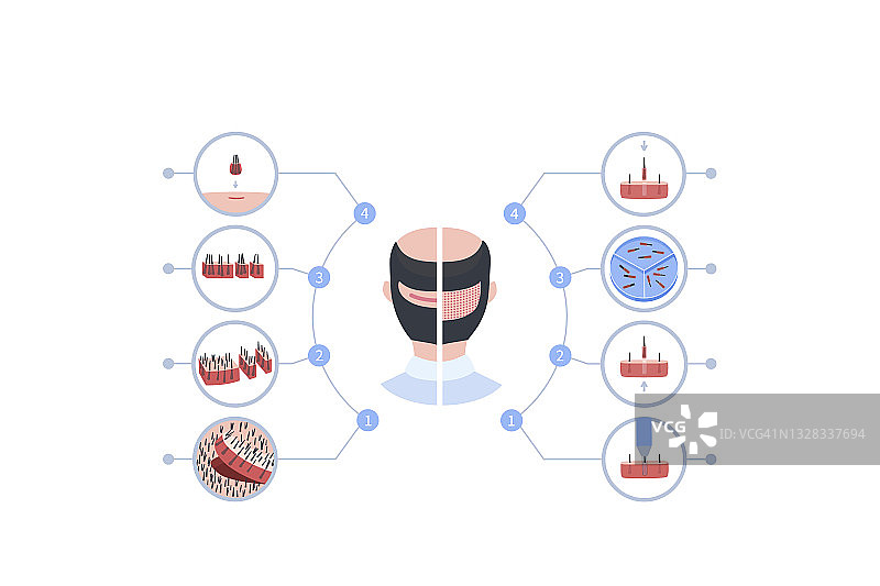 FUE与FUT毛发移植对比插图图片素材