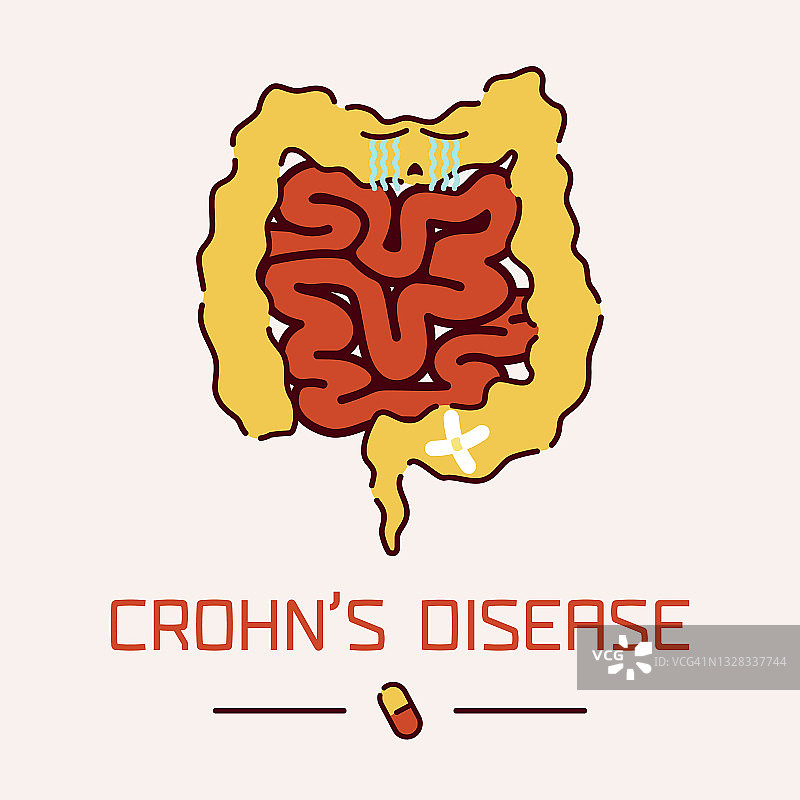 克罗恩病概念图图片素材