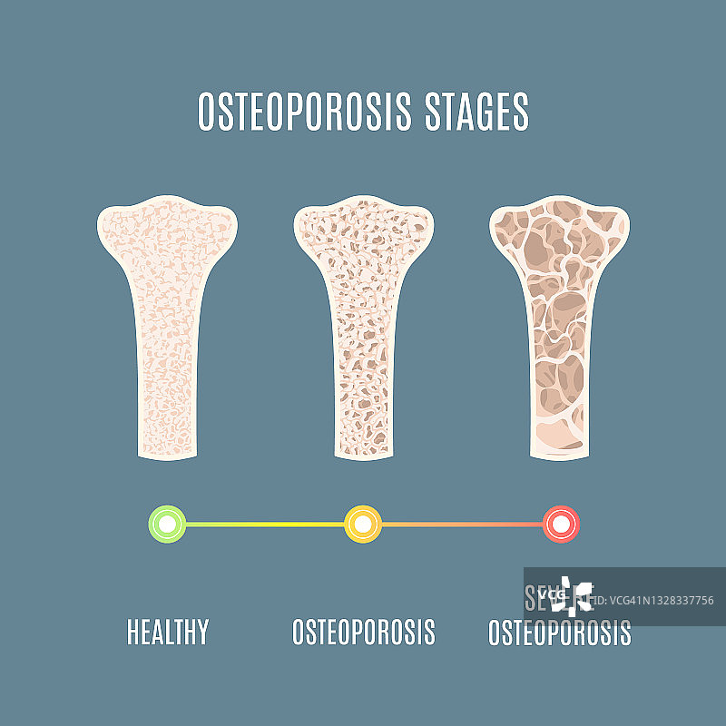 骨质疏松症，图示图片素材