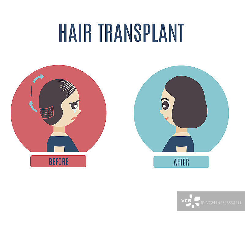 女性头发移植插图图片素材