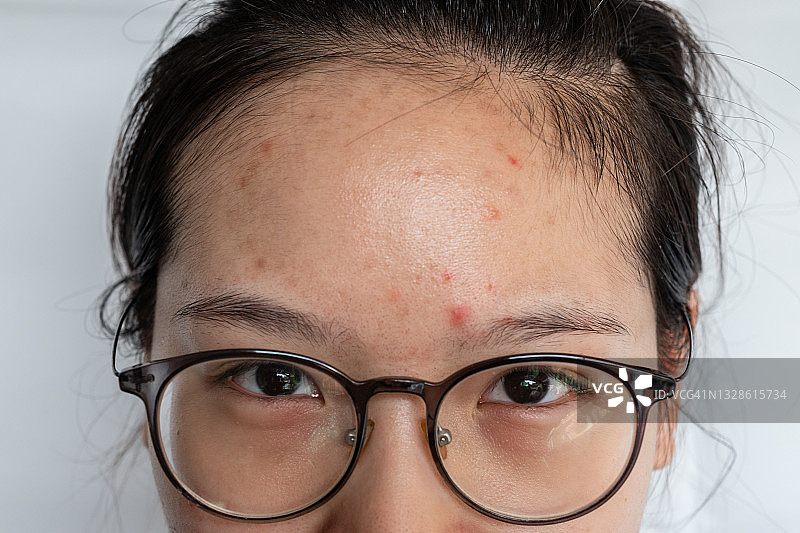 年轻亚洲女人额头粉刺痤疮发炎特写图片素材