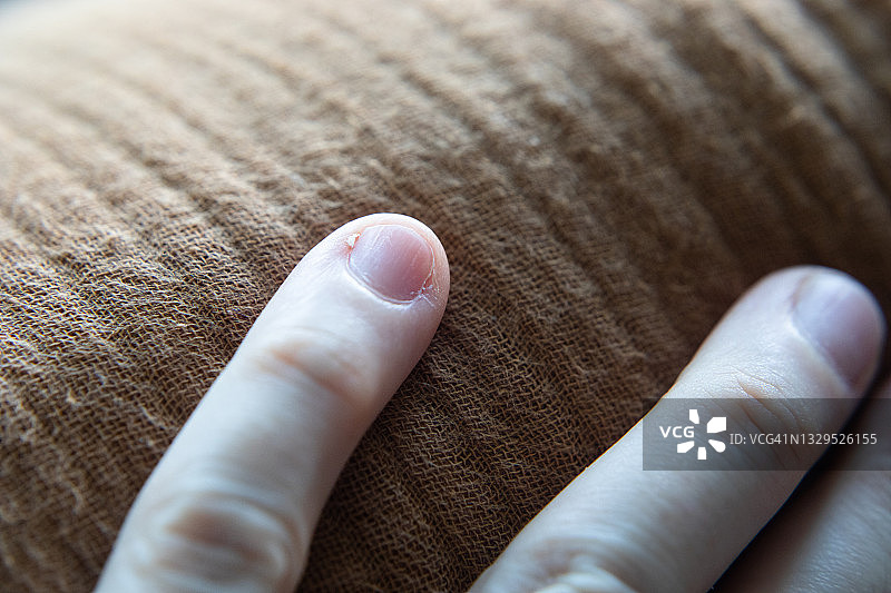 小指上的倒刺图片素材