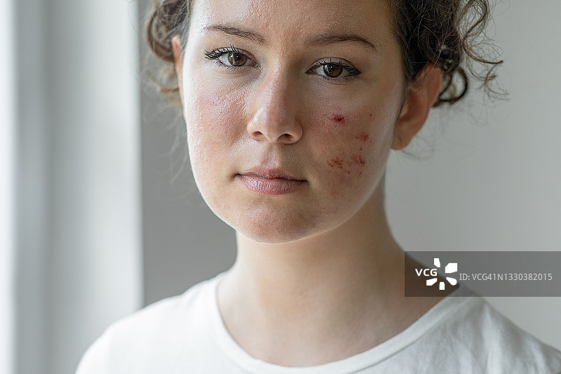 女人有面部皮肤问题图片素材