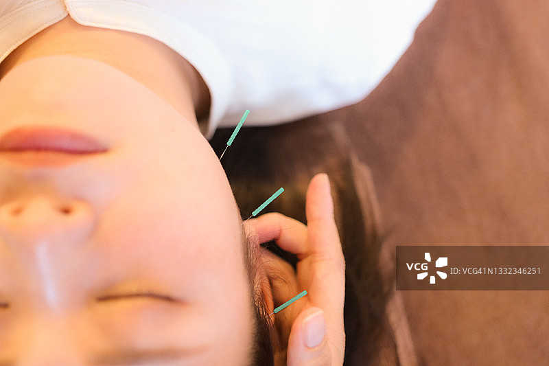 亚洲女性面部美容针灸图片素材