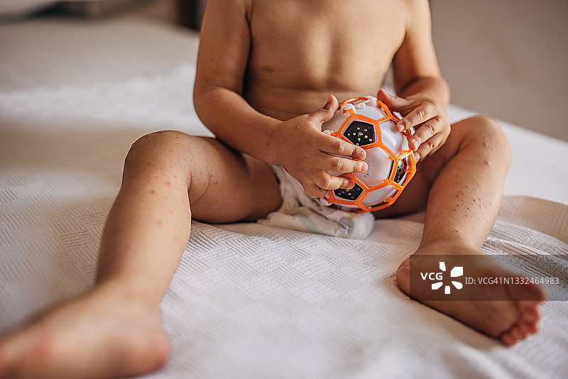 患有手足口病的孩子图片素材