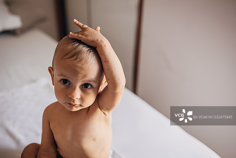 患有手足口病的男婴图片素材