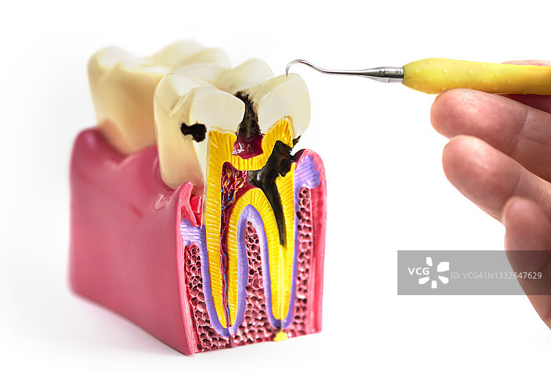 显示龋齿的牙齿解剖模型图片素材
