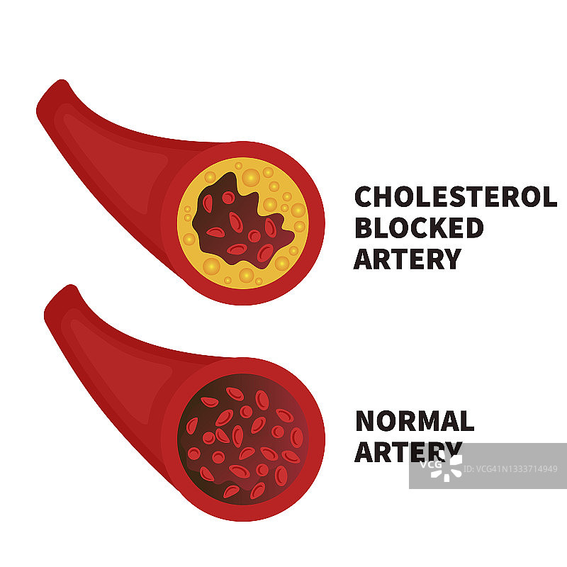 高脂血症概念图图片素材