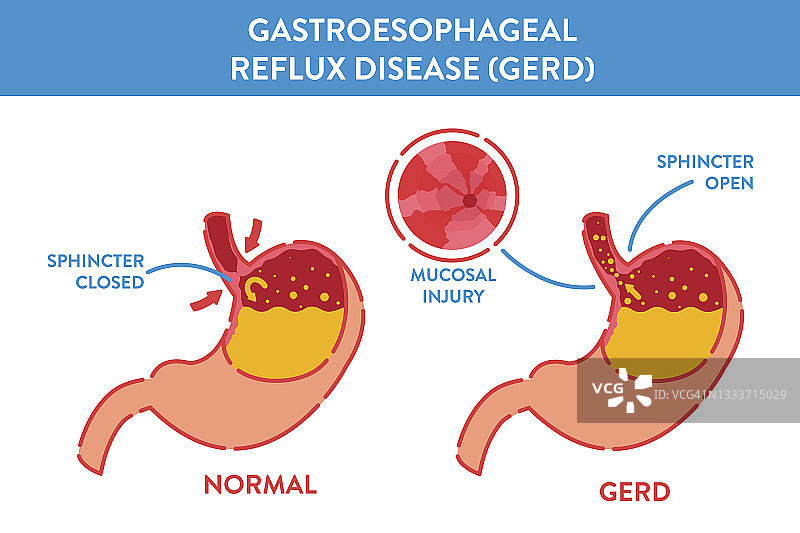 胃食管反流疾病图示图片素材