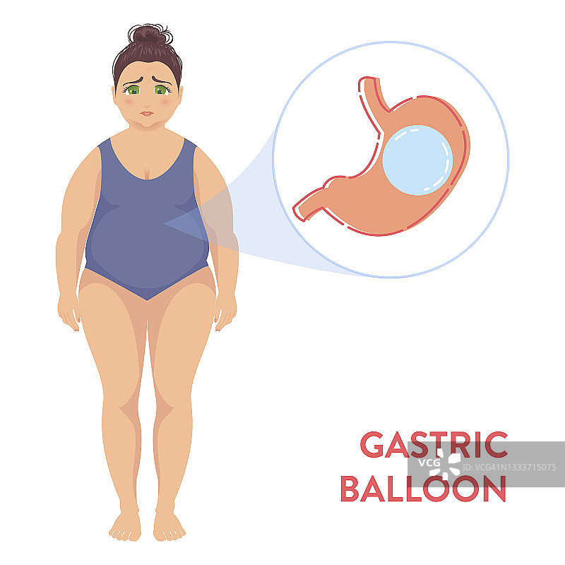 胃球囊概念图图片素材