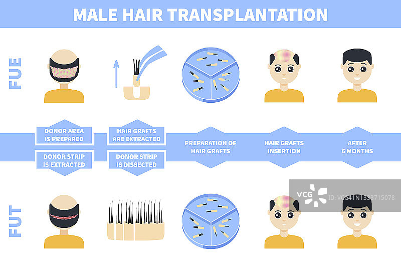 男性植发插图图片素材
