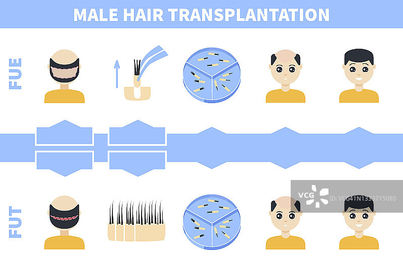 男性植发插图图片素材