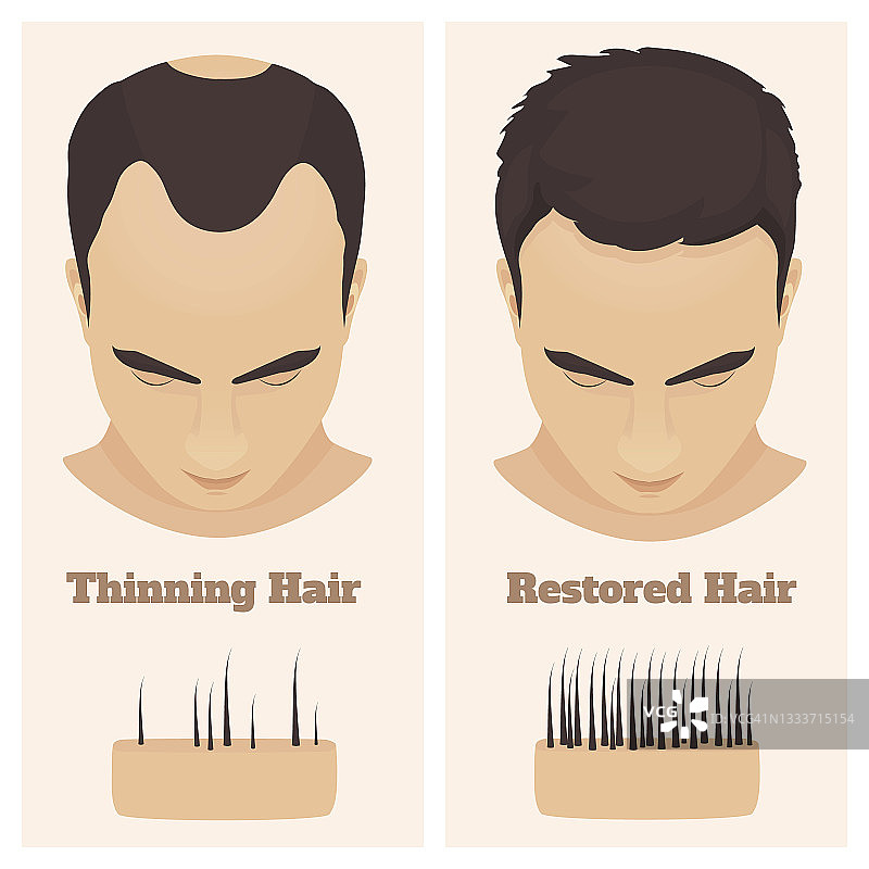 男性型脱发示意图图片素材
