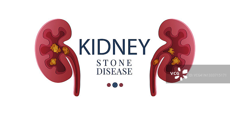 肾结石疾病概念图图片素材