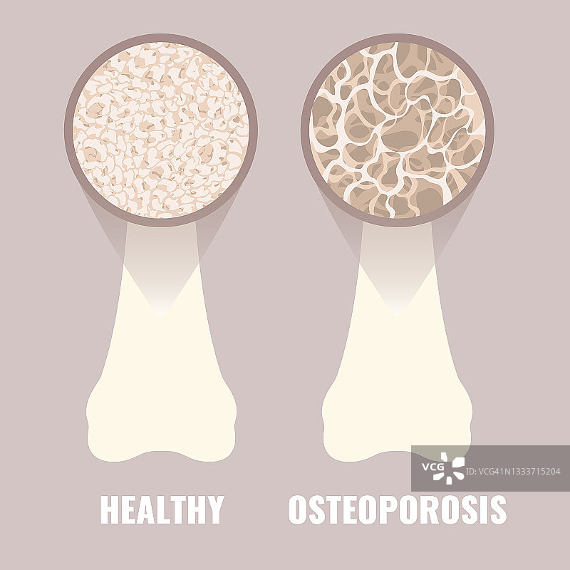 骨质疏松症概念图图片素材