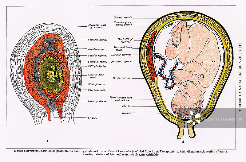 胎儿在子宫内的位置：古老的雕刻插图图片素材