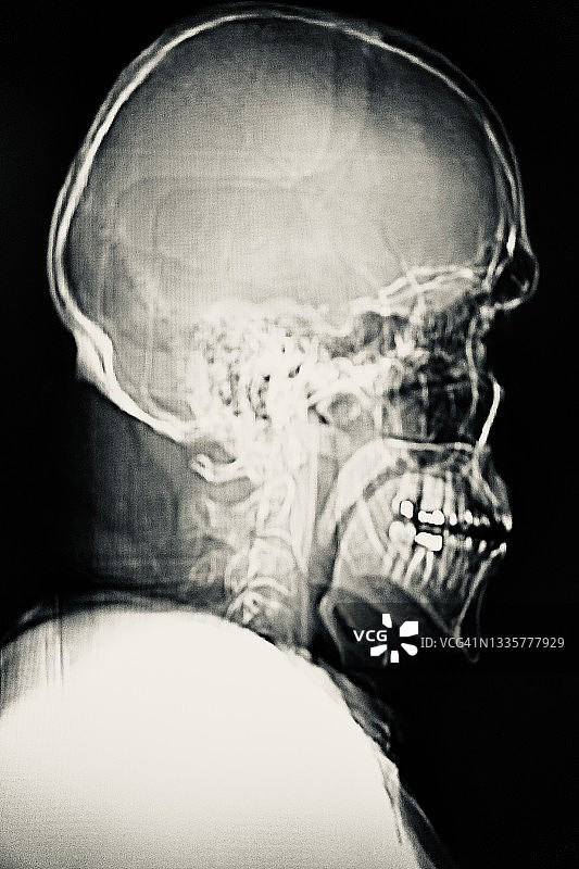 正常人头颈部的核磁共振扫描图片素材