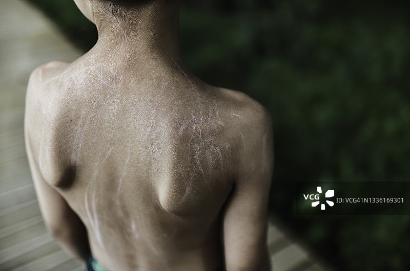 背部有划痕的男孩图片素材