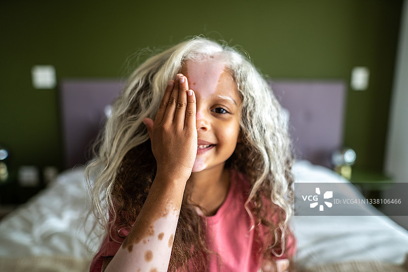 在家用一只手遮住半张脸的白癜风女孩肖像图片素材