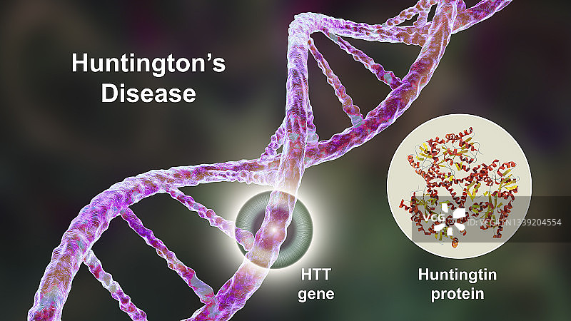 亨廷顿舞蹈症概念图图片素材