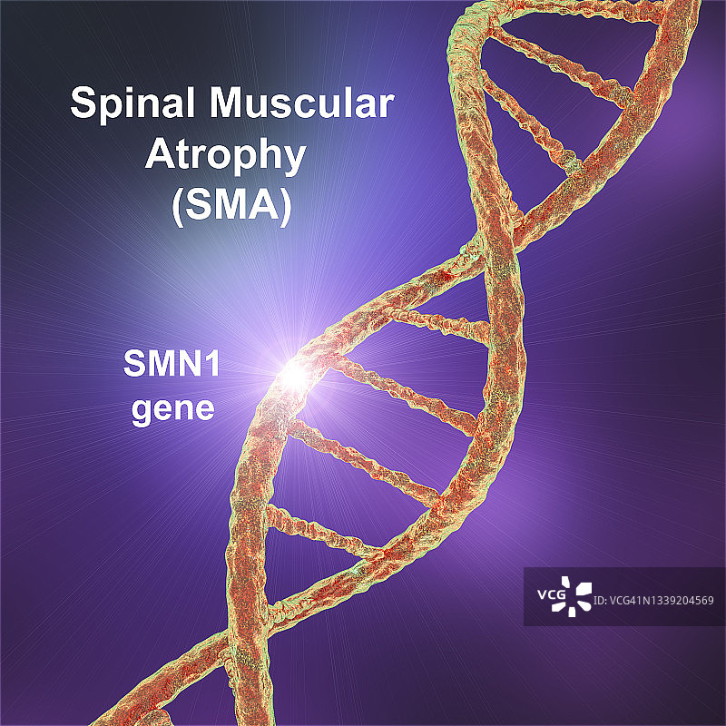 脊髓性肌萎缩症插图图片素材